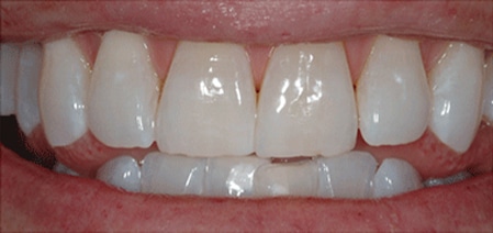 Photo of teeth after using philips zoom whitening show teeth visibly whiter