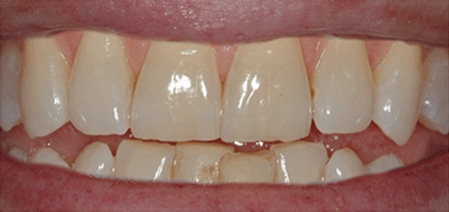 Photo of teeth before using philips zoom whitening