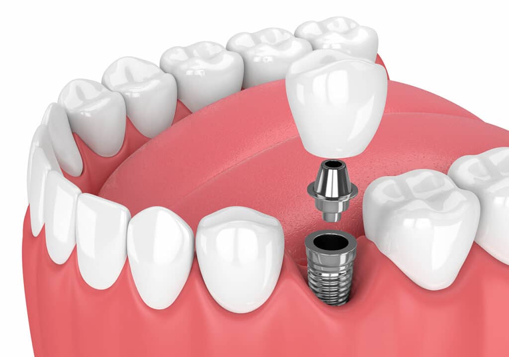 dental implant screws Brentwood