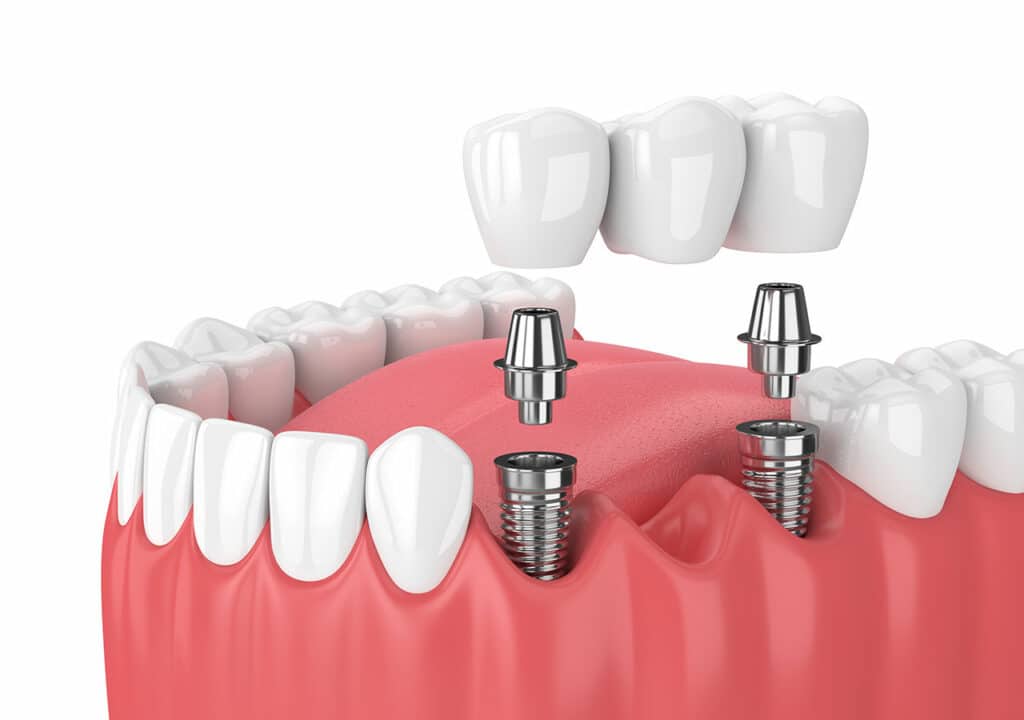 Dental diagram showing two dental implants used to support a dental bridge