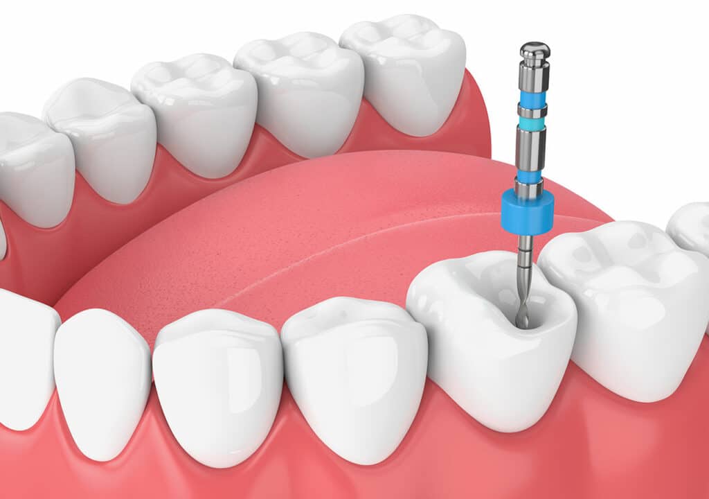 Dental diagram showing the process of a root canal treatment at Blue Gum Dental