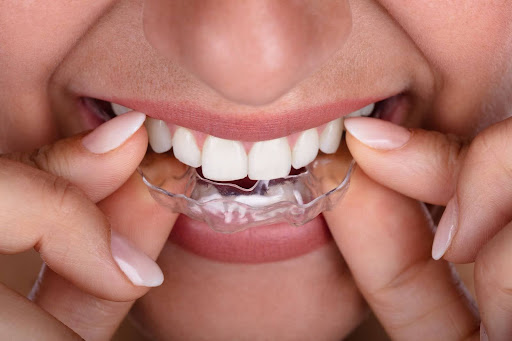 clearcorrect aligners