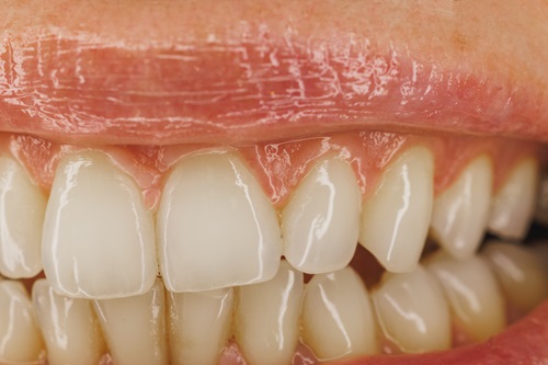 Close Up Of A stained Teeth Smiling Mouth Of A Woman