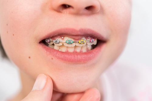 Little girl with rainbow braces