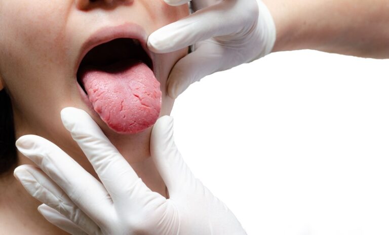 Tongue of a young Caucasian woman with benign migratory glossitis, candidiasis.
