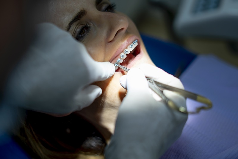 Woman at dentist placing braces on teeth