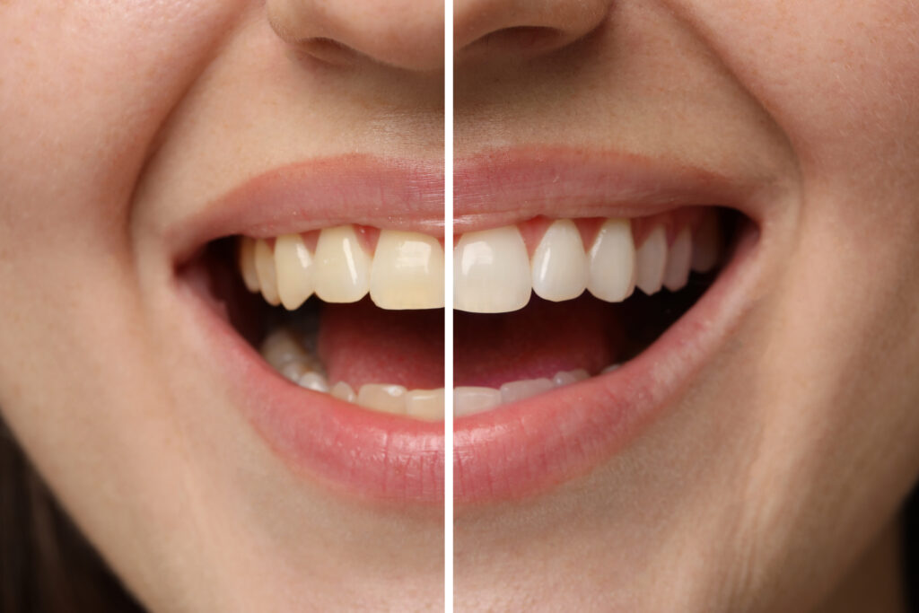 Brown staining and discolouration visible on teeth