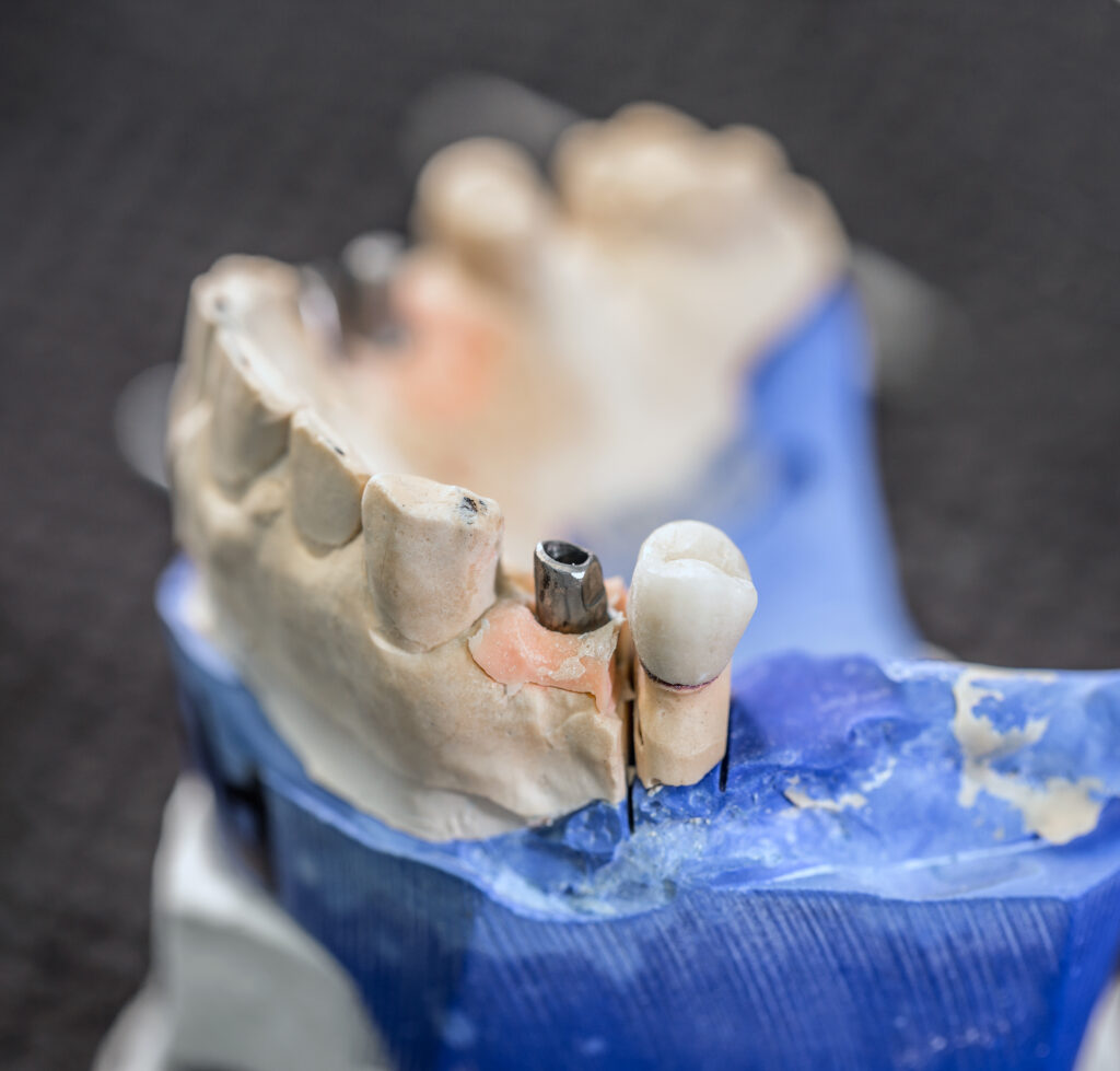 Dental model showing a bone graft area next to an implant abutment and crown in the lower jaw