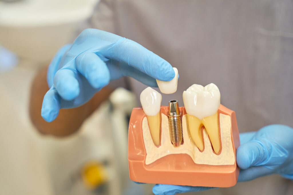 Dentist placing a crown onto a dental implant model, showing the titanium implant post next to a natural tooth in a cross-section jaw