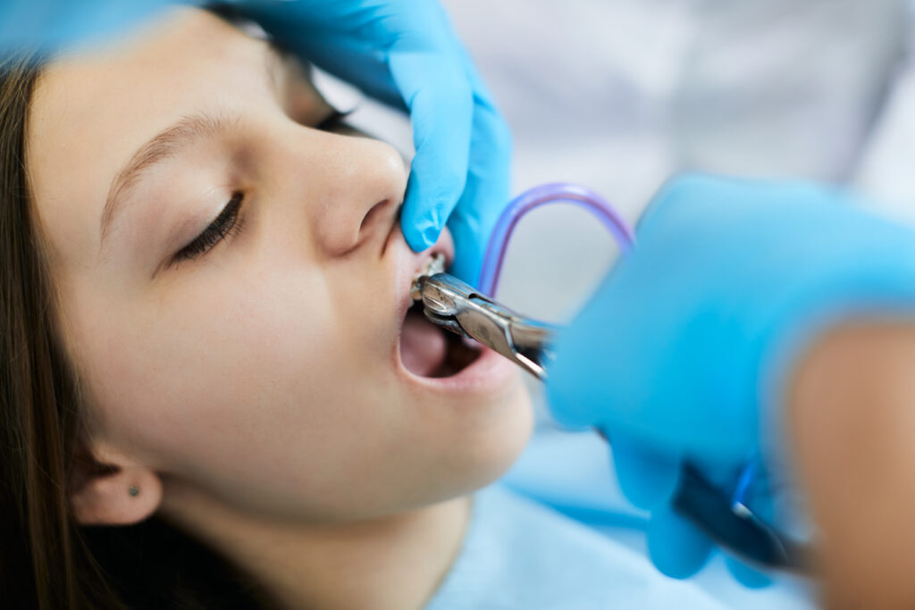 Dentist using extraction forceps to remove a patient's tooth, a step that precedes following proper aftercare instructions for healing.