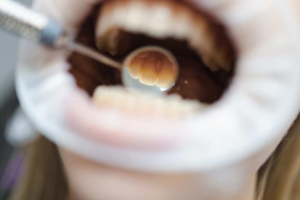 Dentist using a dental mirror to check the back of a patient’s upper front teeth during an exam for inlays and onlays